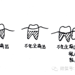 新加坡看牙贵不贵|新加坡拔智齿小记,花了1100新币 (5000RMB)!