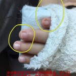 2岁娃到新加坡私人医院看急诊,满手针眼被赶出来