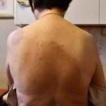 顽固皮肤病久治未果,终被中国家庭常备药治愈~