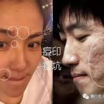 爆痘、毛孔粗大、闭口还能拯救吗?当然能!