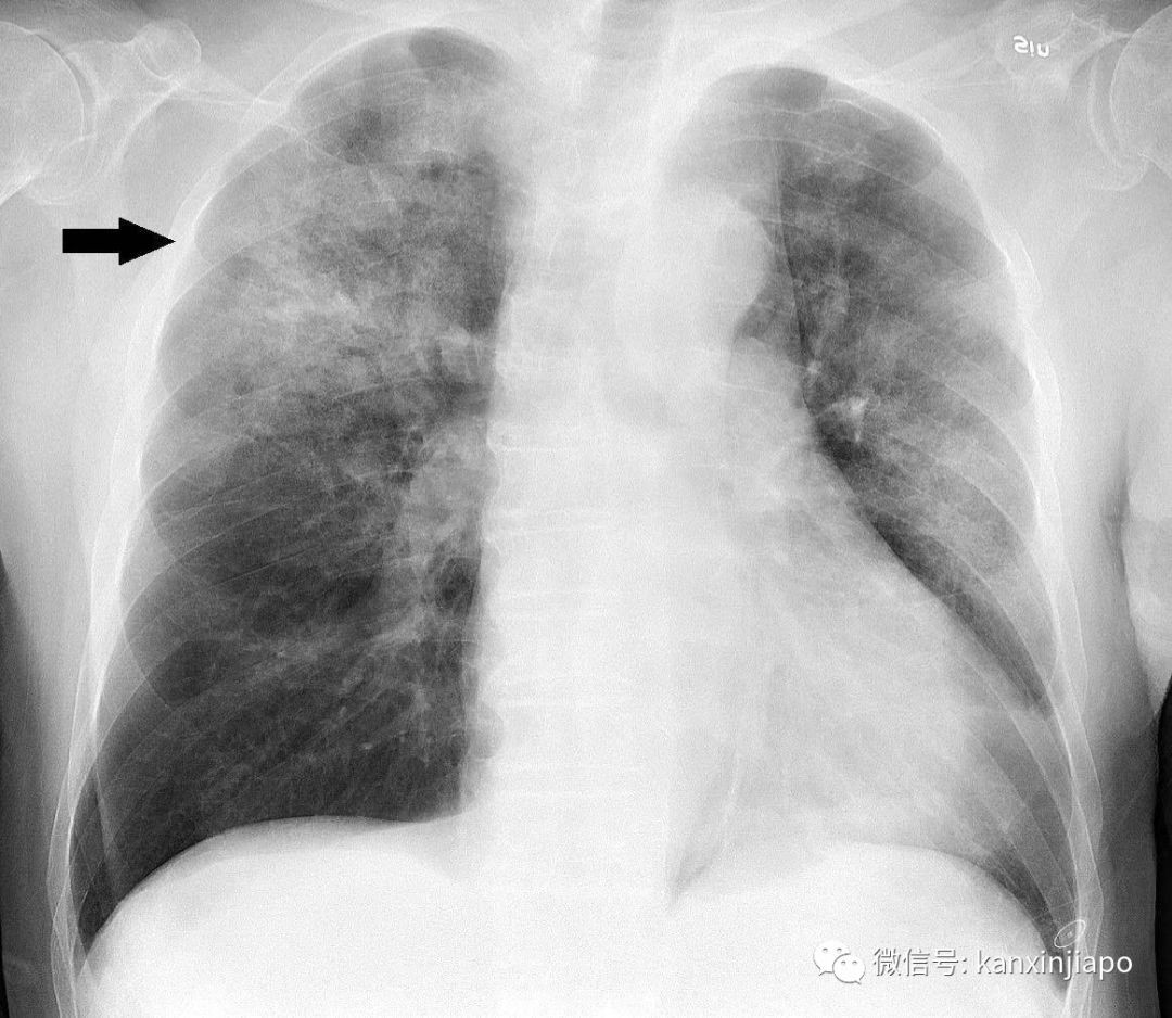 卫生部公布肺炎最新进展，新加坡严防死守排查一切可能性