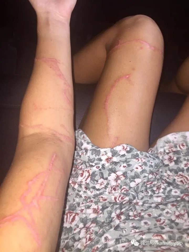 新增X，累计X | 4岁女童在圣淘沙海滩嬉水，被剧毒水母蜇伤