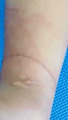 新增X，累計X | 4歲女童在聖淘沙海灘嬉水，被劇毒水母蜇傷