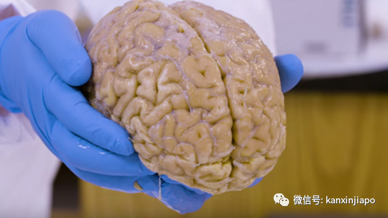 捐脑袋？新加坡脑库开幕一周年，迎来首两颗大脑捐赠