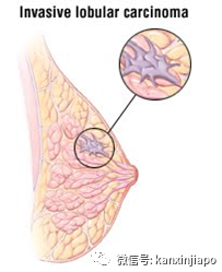 180份乳腺癌報告全錯,新加坡醫院5名職員遭到處分