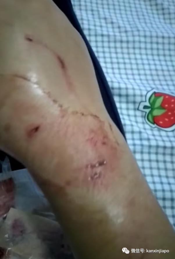 鲜血直流！新加坡女佣被狗咬伤，雇主拖2天才送医