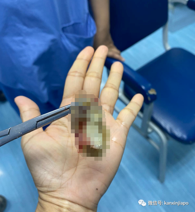 年轻病患浓痰卡喉咙进ICU，医生：冠病不是普通感冒