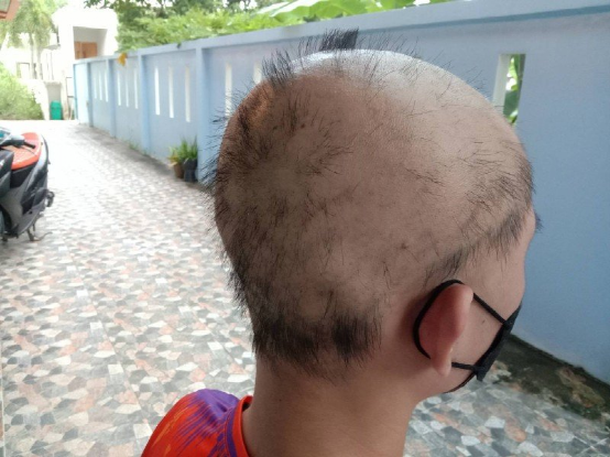 好惨！19岁少年接种疫苗后惨变秃头