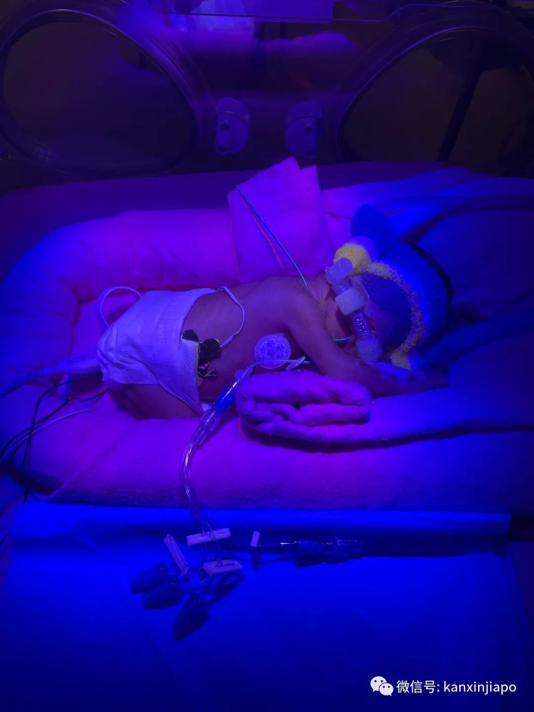 這個生下來只有1030克的極度早産兒,活下去還需要幾十萬新幣...