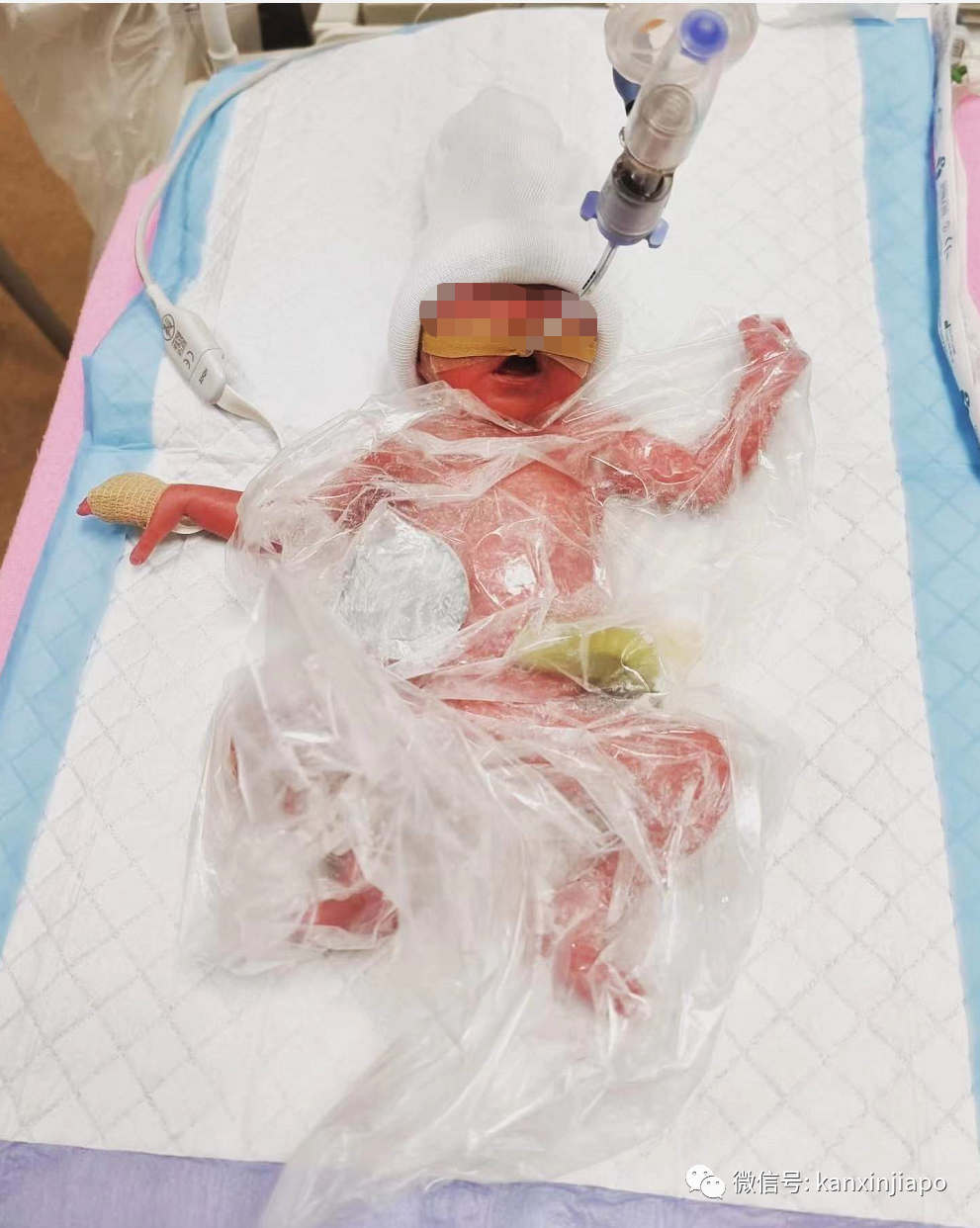 這個生下來只有1030克的極度早産兒,活下去還需要幾十萬新幣...