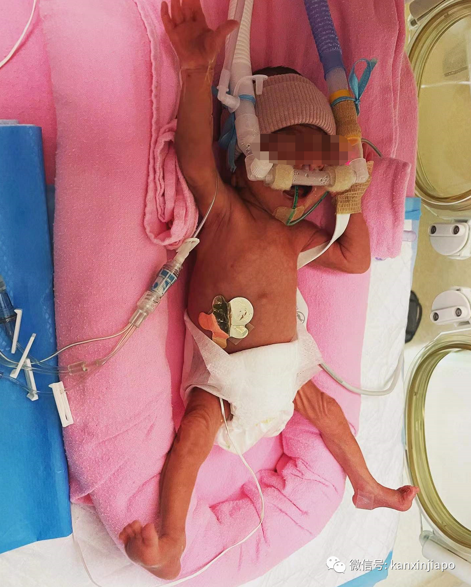 這個生下來只有1030克的極度早産兒,活下去還需要幾十萬新幣...