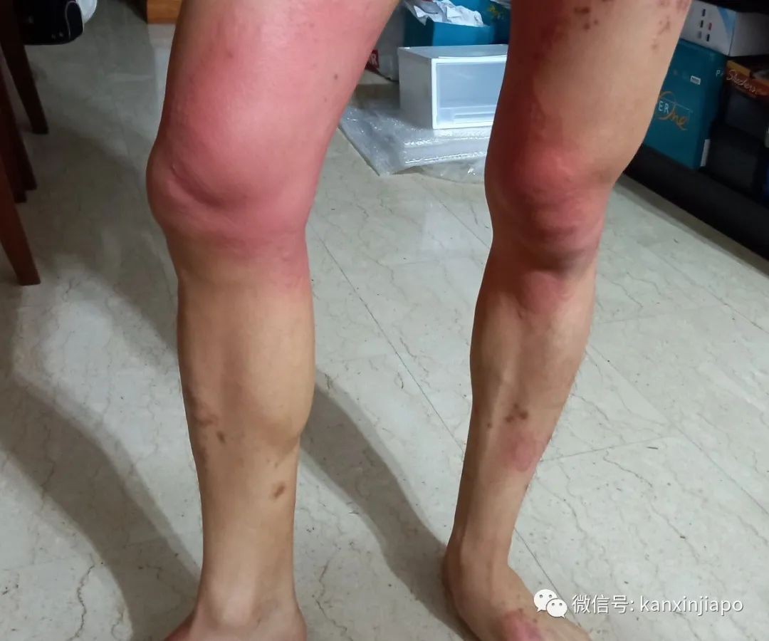 全身奇癢無比,新冠也能引起皮膚病?