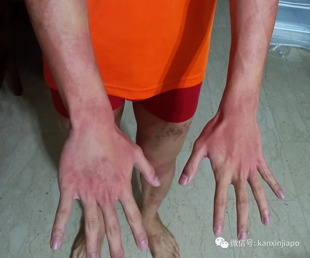 全身奇癢無比,新冠也能引起皮膚病?