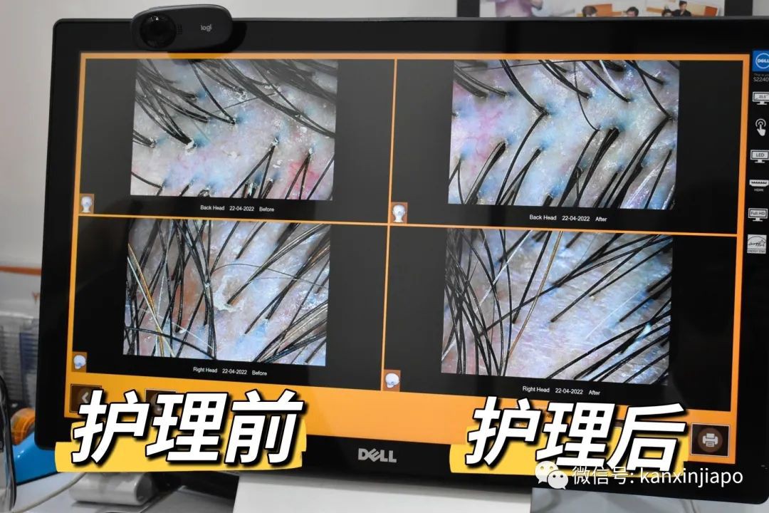 来新加坡后疯狂掉发？！原因竟是这个！