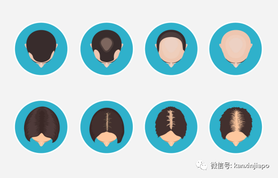 来新加坡后疯狂掉发？！原因竟是这个！