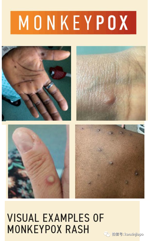 新加坡新增两起猴痘病例；患者痛楚难当，康复后心有余悸