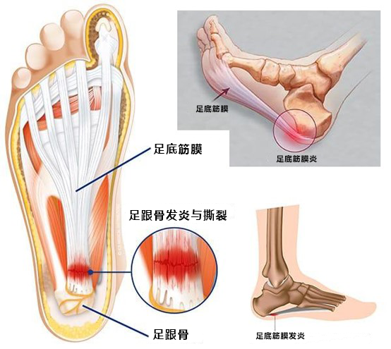 步步无忧:揭秘脚底板疼痛之谜及瞬间缓解妙招!