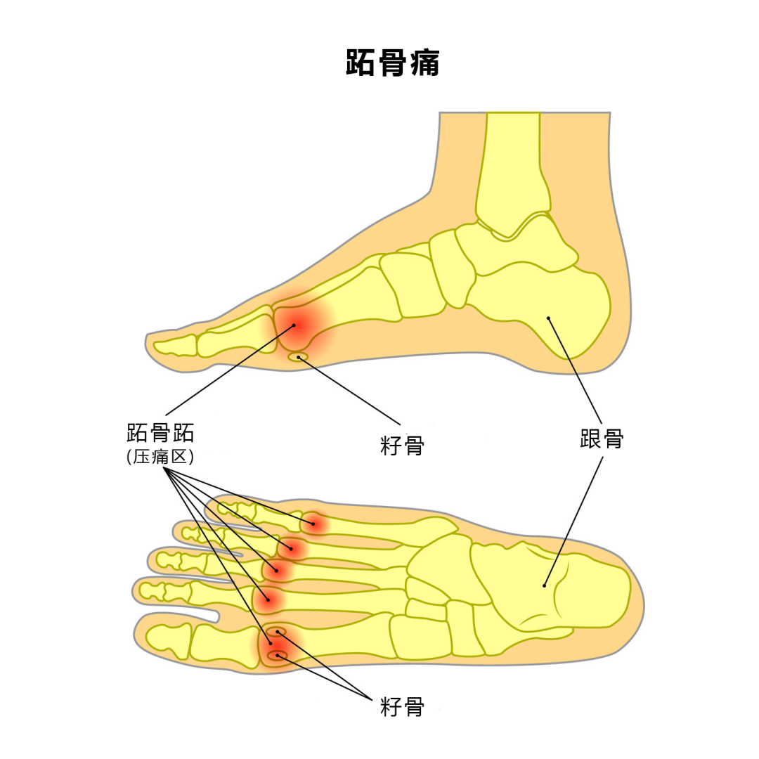 步步无忧:揭秘脚底板疼痛之谜及瞬间缓解妙招!