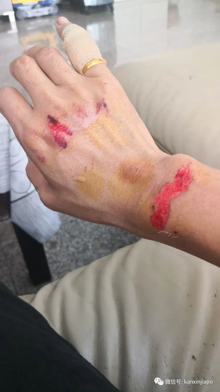 7岁新加坡男孩在新山险遭熟人绑架,父亲为救儿摔断两颗牙