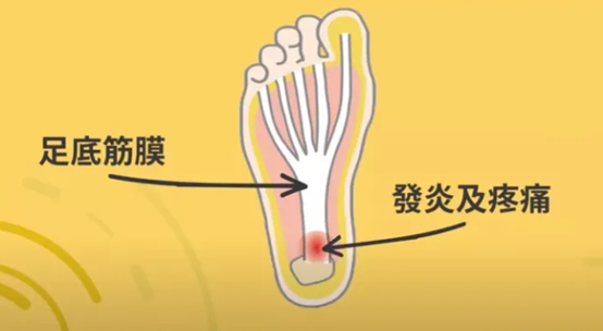 步步无忧:揭秘脚底板疼痛之谜及瞬间缓解妙招!