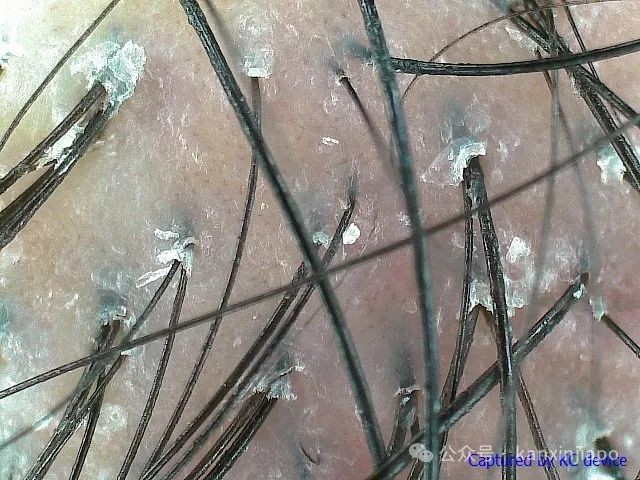 高温闷热！我在新加坡热到头皮出油、头痒，头发还狂掉！
