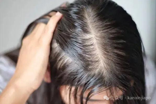 高温闷热！我在新加坡热到头皮出油、头痒，头发还狂掉！