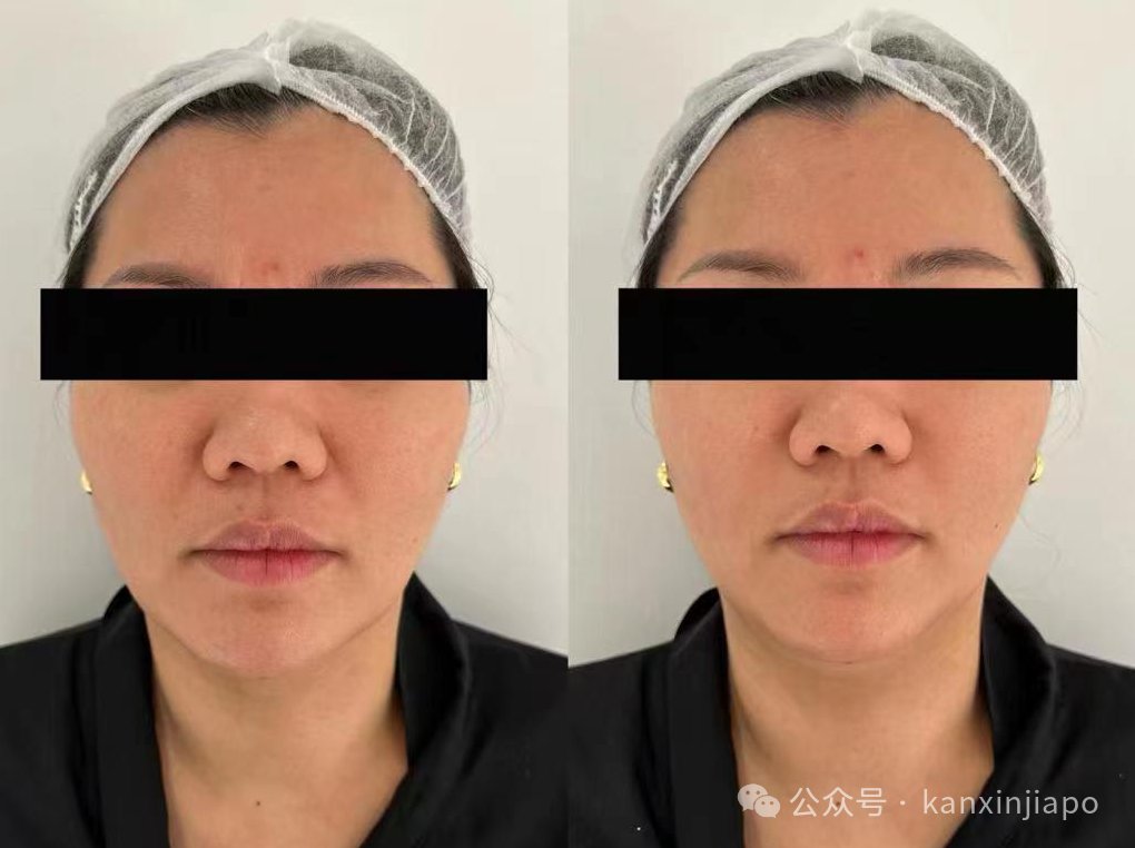 在中国和新加坡,哪里打玻尿酸便宜?